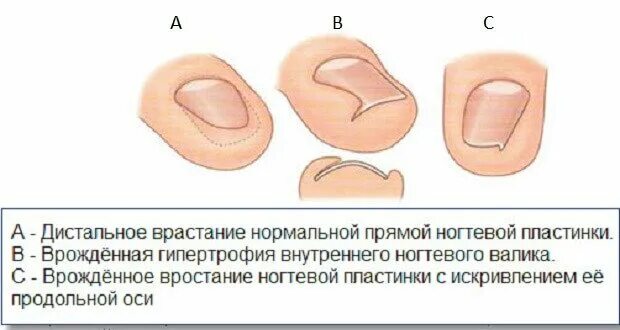 Ноготь в рос что делать