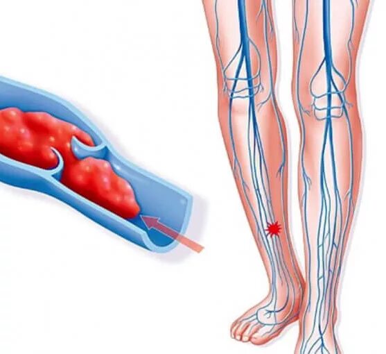 Как почистить тромбы. Тромбофлебит бедренной вены. Острый тромбоз вен нижних конечностей. Острый варикозный тромбофлебит.