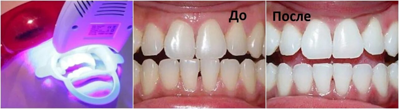 Лазерное отбеливание зубов. Отбеливание зубов до и после. Лазерное отбеливание зубов до и после.