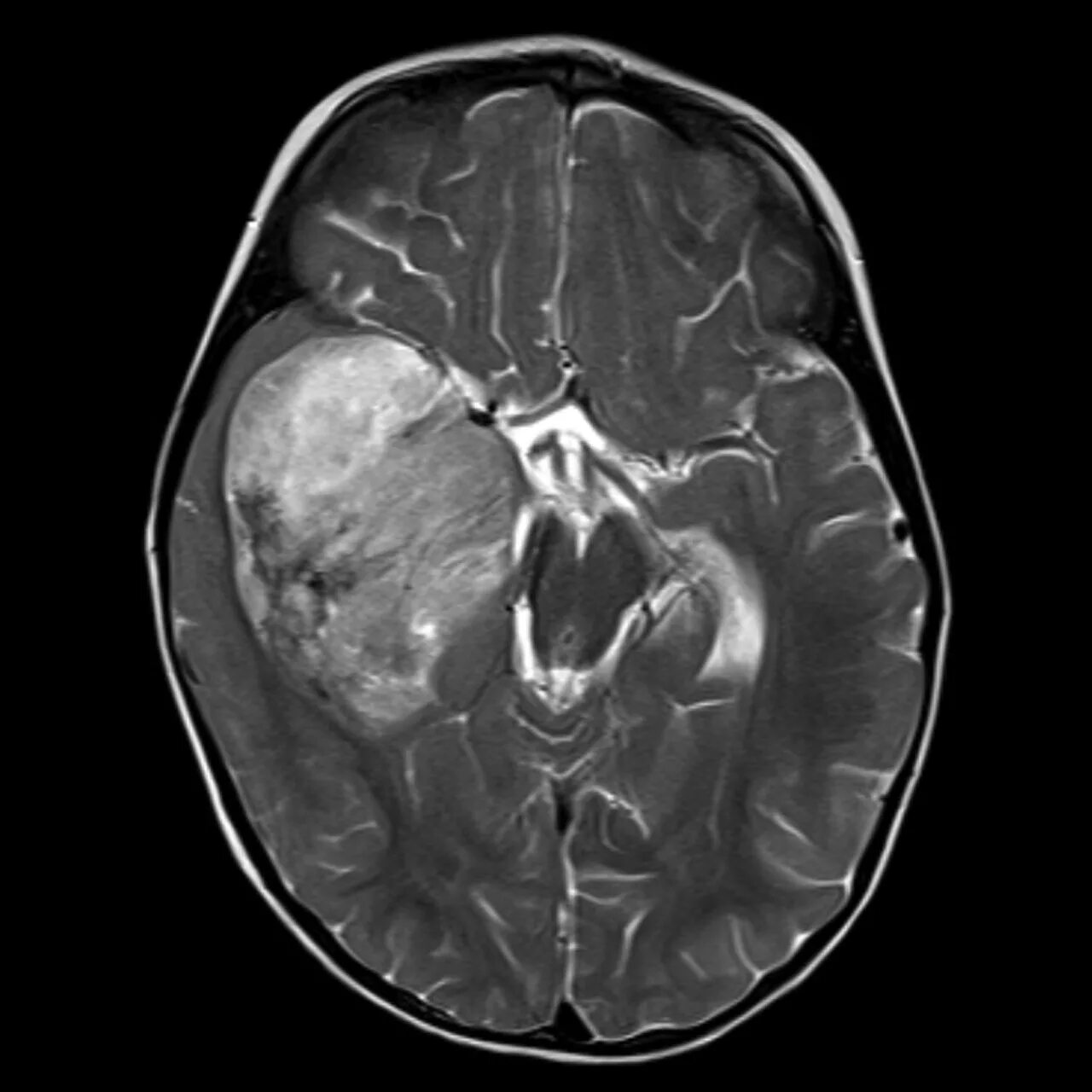 Глиома у детей. Диффузная глиома ствола головного. Глиома ствола мозга мрт. Диффузная глиома ствола мозга мрт.