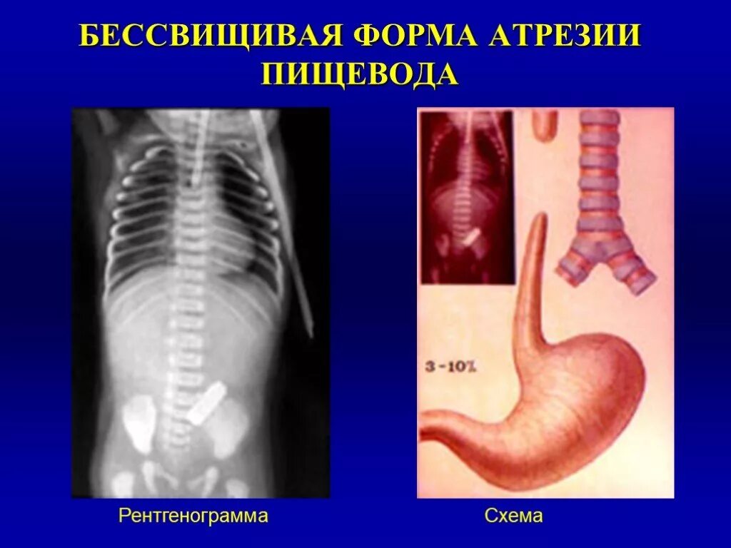 Пищевод у детей. Клиника свищевой формы атрезии пищевода. Атрезия пищевода с трахеопищеводным свищем ?. Атрезия пищевода детская хирургия. Анатомические формы атрезии пищевода.