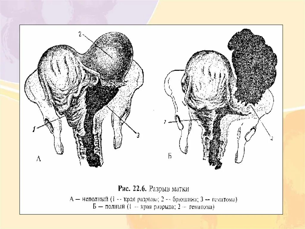 Полный и неполный разрыв матки. Разрыв матки по локализации.