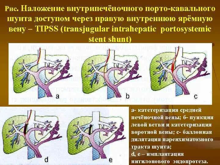 Внутрипеченочный портокавальный шунт. Катетеризация воротной вены. Шунтирование воротной вены. Катетеризация печеночной вены.