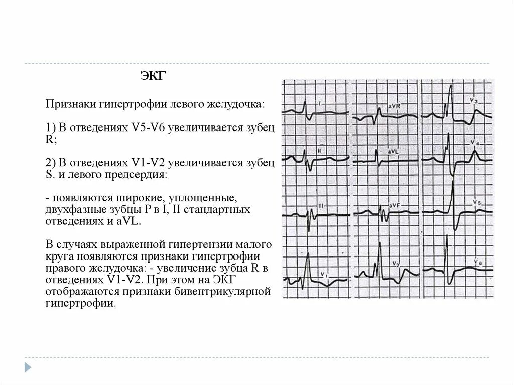 ЭКГ синдром гипертрофии желудочков. Гипертрофия левого желудочка на ЭКГ. ЭКГ- критерии гипертрофии лж. Электрокардиограмма с гипертрофией левого желудочка. Экг преобладание левого желудочка