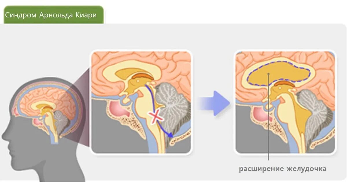 Аномалия арнольда киари что это простыми. Аномалия мозга Арнольда Киари. Синдром Арнольда-Киари 1. Аномалия Арнольда-Киари 1 степени у детей.