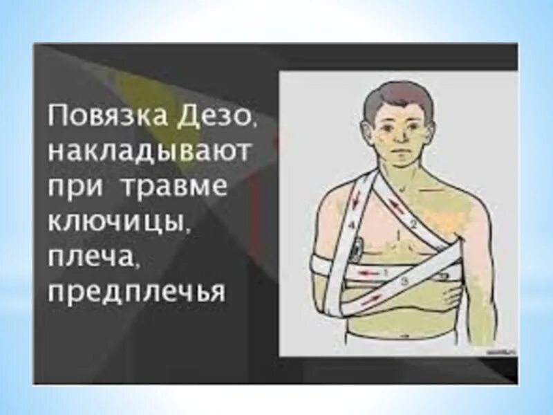 Порядок наложения повязки Дезо. Десмургия Дезо. Иммобилизация Дезо. Перелом ключицы повязка Дезо.