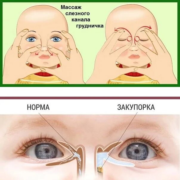 Слезный канал форум. У грудничка гноится глазик. Массаж слезного канала у новорожденных. Закупорка слезного канала. Массаж слезного канала й у ребёнка.