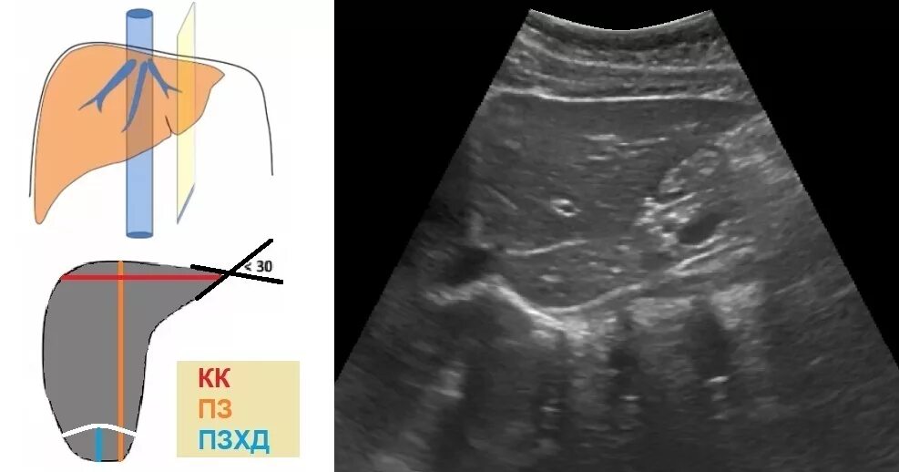Нормальные Размеры долей печени на УЗИ. Размеры левой доли печени в норме у взрослых на УЗИ. Измерение правой доли печени на УЗИ. Узи печени схема