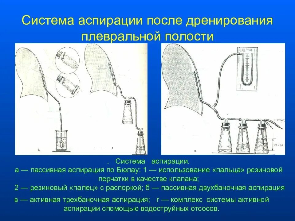 Аспирация содержимого