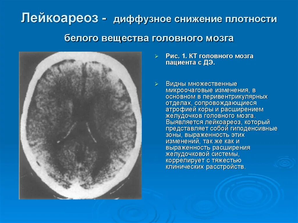 Диффузно атрофические изменения. Кт признаки лейкоареоза головного мозга. Перивентрикулярное снижение плотности вещества головного мозга. Перивентрикулярный лейкоареоз головного мозга мрт. Снижение плотности белого вещества мозга кт.