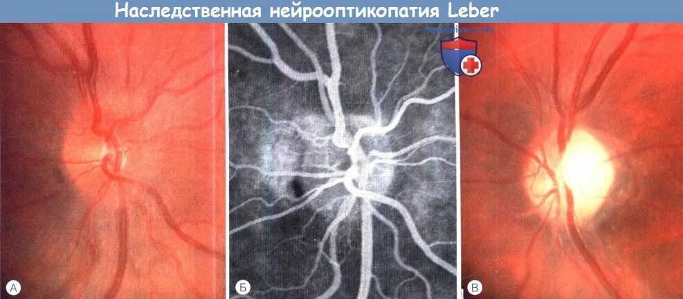 Атрофия зрительного нерва у детей. Нейропатия зрительного нерва Лебера. Наследственная оптическая нейропатия Лебера. Наследственная атрофия зрительного нерва Лебера.