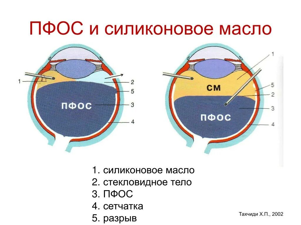 После удаления силиконового масла. Масло пмс 100 расшифровка. После удаления силиконового масла. После удаления силиконового масла. Пмс-10000 масло для вискомуфты артикул.