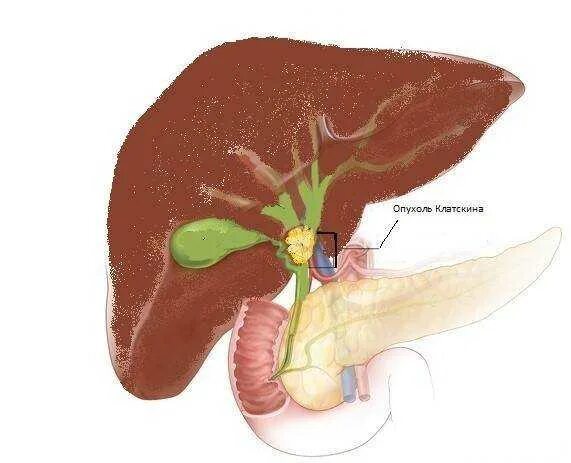 Болезни желчного протока. Опухоли внепеченочных желчных протоков. Холангиокарцинома желчных протоков. Опухоль печени клацкина.