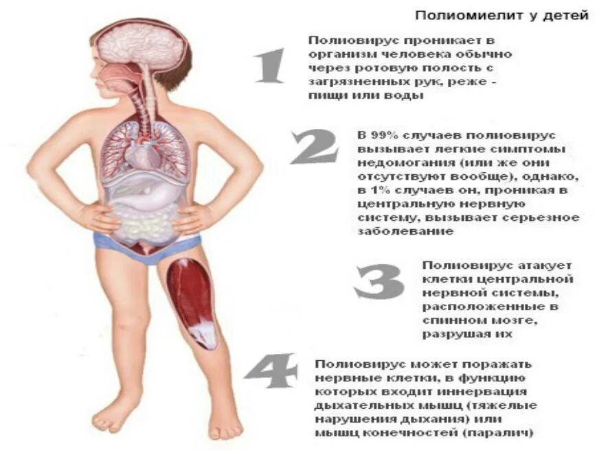 Насморк полиомиелит. Осложнения прививки полиомиелит. Осложнения при полиомиелите. Полиомиелит детский паралич. Профилактика полиомиелита у детей.