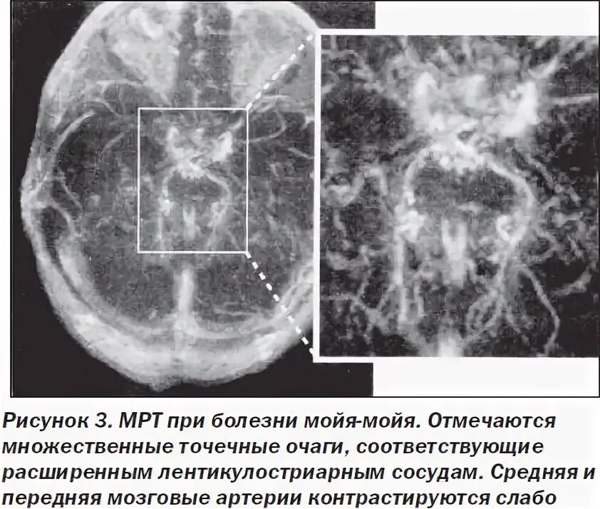 Болезнь мойамойа ангиография. Болзни моя моя. Моя моя болезнь причины. Болезнь моя моя ангиография. Моя моя болезнь симптомы.