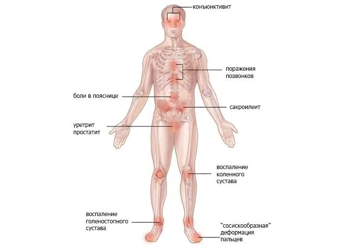 Болезнь рейтера что это. Синдром Рейтера этиология. Синдром Рейтера суставной синдром. Болезнь Рейтера патогенез. Синдром Рейтера уретрит.