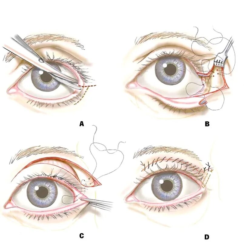 Кантопексия, кантопластика (подтяжка угла глаза). Операция латеральная кантопластика. Кантопексия миндалевидные глаза. Латеральная кантопластика глаз.