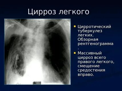 Цирроз легкого