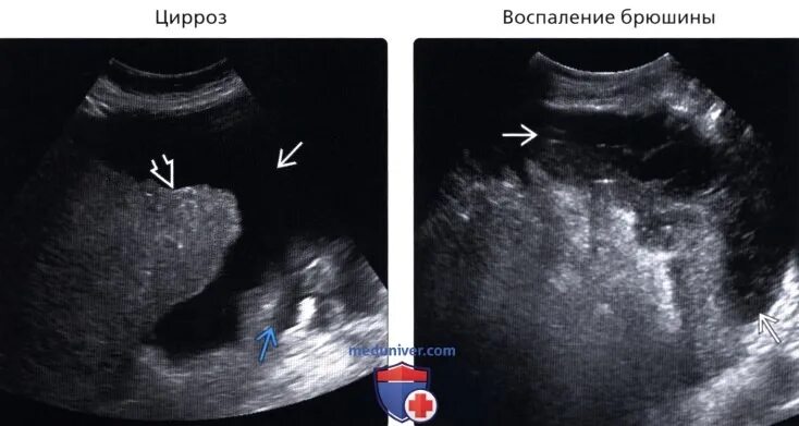 Узи литр воды. Свободная жидкость асцит УЗИ. Жидкость в брюшной полости на УЗИ. Свободная жидкость в брюшной полости на УЗИ. УЗИ картина свободной жидкости в брюшной полости.