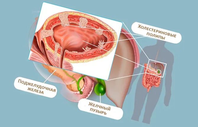 Народное лечение полипа в желчном пузыре. Пристеночный полип желчного пузыря. Полип желчного пузыря на УЗИ. Ультрасонография желчного пузыря полип.
