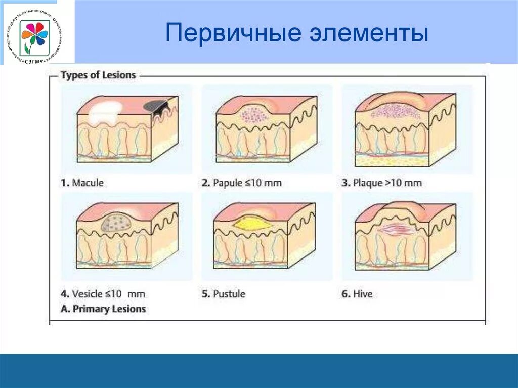 Вторичные элементы поражения