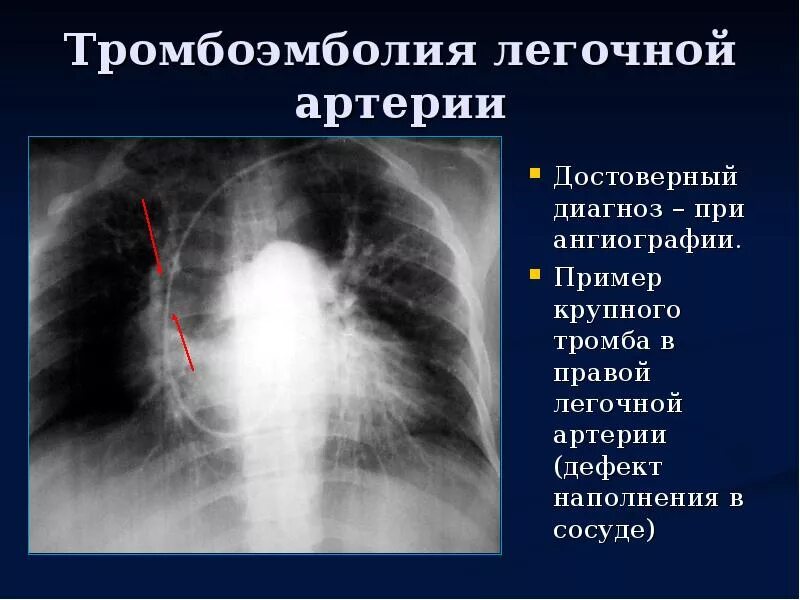 Тромбоэмболия мелких легочных ветвей. Тромбоэмболия мелких ветвей легочной артерии рентген. Инфаркт легкого при Тэла рентген. Тромбоэмболия рентген признаки.