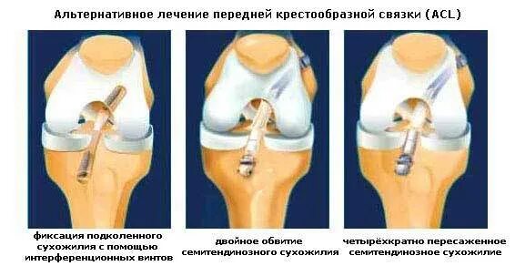 Разрыв связок ПКС коленного сустава. Операция на мениск и крестообразную связку коленного сустава. Артроскопия передней крестообразной связки коленного сустава. Артроскопия ПКС коленного сустава. Операция коленный сустав новосибирске