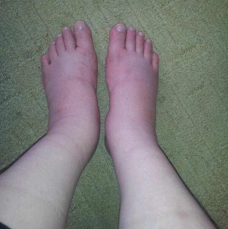 Пастозность. Пастозность. Пастозность голеней и стоп что это. Пастозность нижних конечностей. Облитерирующий тромбофлебит.