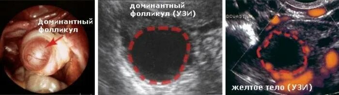 Доминантный фолликул в правом яичнике 18 мм. Доминантный фолликул на УЗИ. Лечение фолликулов