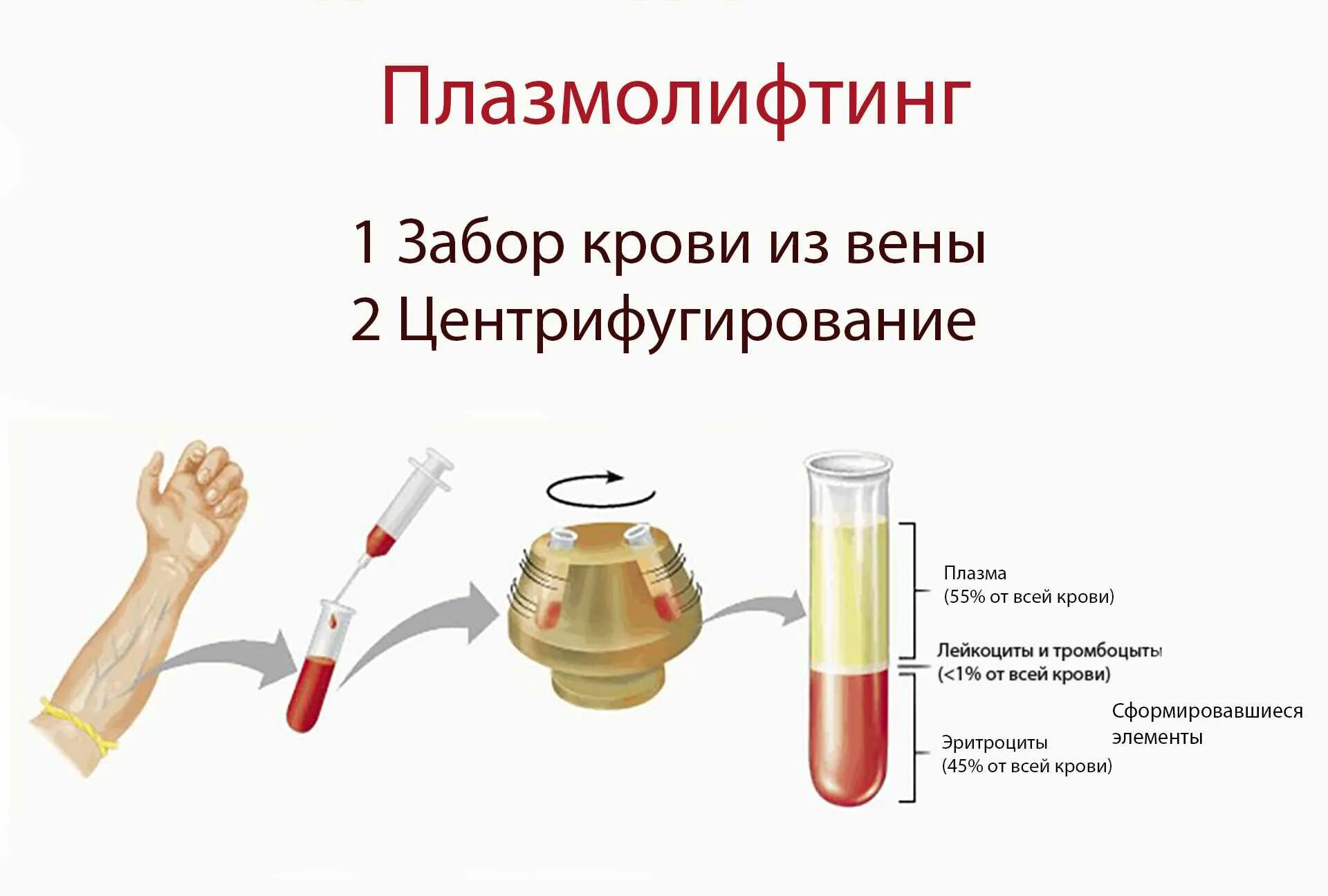 Плазмолифтинг сколько нужно процедур. Плазмолифтинг протокол проведения. Введение плазмы обогащенной тромбоцитами. Плазмолифтинг этапы процедуры.