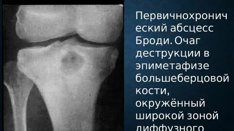 Костных деструктивных