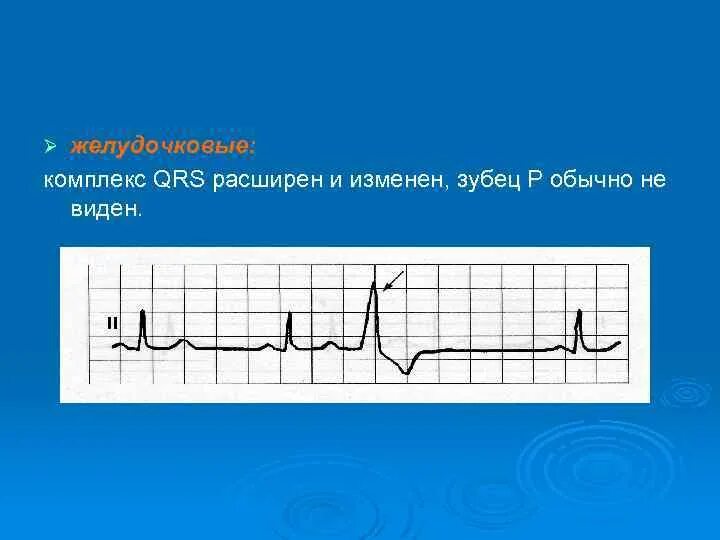 Широкий комплекс qrs. Расширенный qrs. расширение комплекса qrs на экг. расширенный комплекс qrs. расширен qrs.