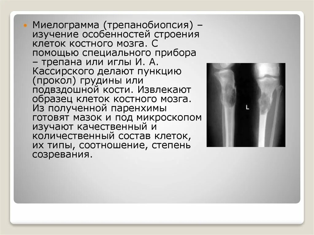 Исследование костного мозга миелограмма трепанобиопсия. Трепанобиопсия крыла подвздошной кости. Миелограмма при заболеваниях. Как делают миелограмму.