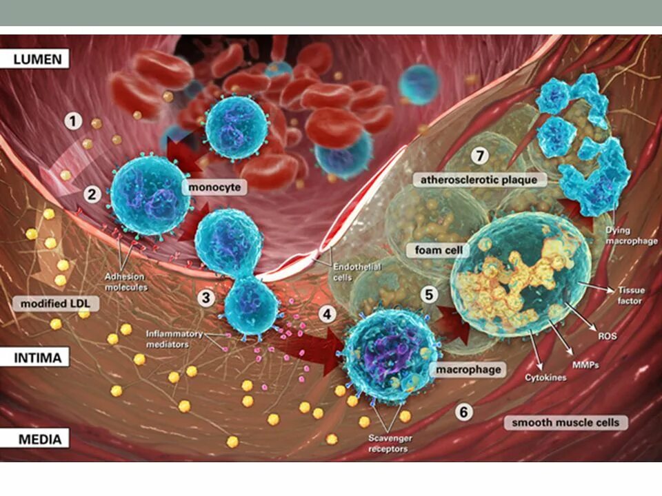 Атеросклероз липосклероз. Стенозирующий атеросклероз. Осложнения атеросклероза коронарных артерий. Воспаление атеросклероз. Холестерин картинки.