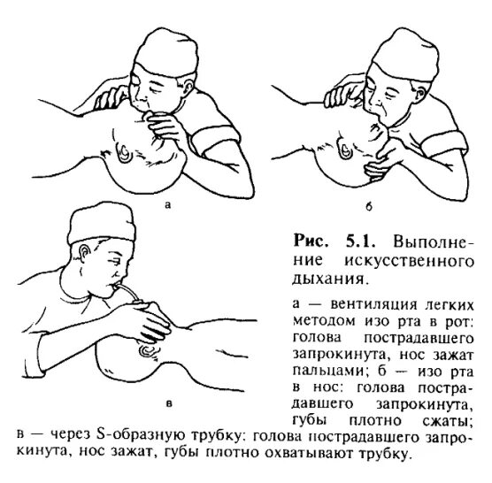 Искуственная вентиляция легких алгоритм кратко