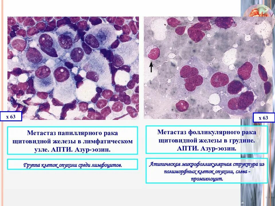 Папиллярная карцинома щитовидной железы гистология. Фолликулярная опухоль щитовидной. Фолликулярная карцинома щитовидной железы.