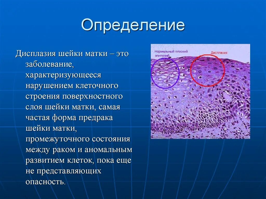 Изменение клеток матки. Дисплазия определение. Как выглядит дисплазия 1 степени. Дисплазия плоского эпителия 1-2 степени что это такое.