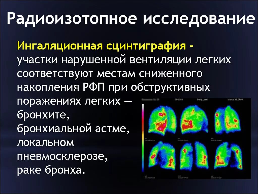 Исследование изотопами. Радиоизотопное исследование (сцинтиграфия почек. Исследование методом радиоизотопной диагностики. Радиоизотопный метод сцинтиграфия. Радиоизотопные методы исследования.