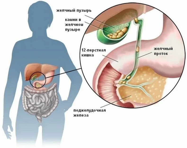 Желчекаменная болезнь холецистит.