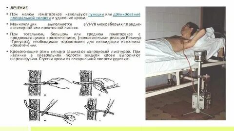 Прокол при пневмотораксе