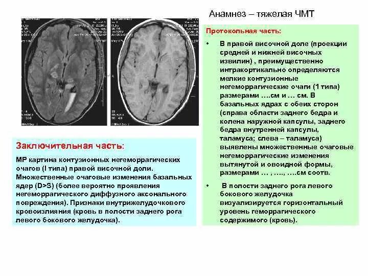 Киста в лобной доле. Очаги в височных долях головного мозга. Кистозные изменения головного мозга. Контузионные очаги головного мозга на кт. Атрофические изменения.