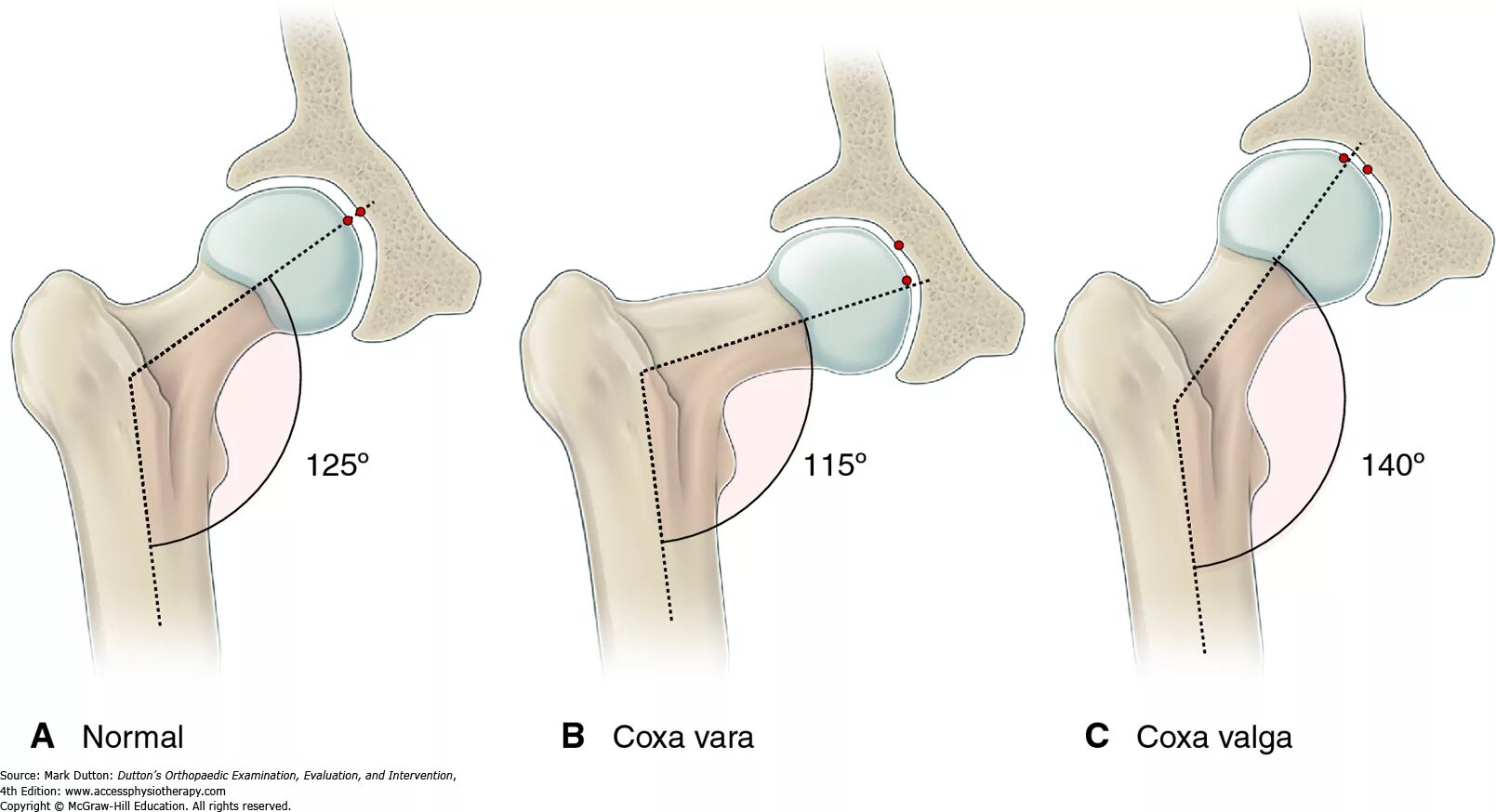 Coxa vara тазобедренного сустава. Варусная деформация тазобедренного сустава. Дисплазия тазобедренных суставов Coxa Valga. Кокса Вальга тазобедренного сустава у детей. Тазобедренные суставы производители