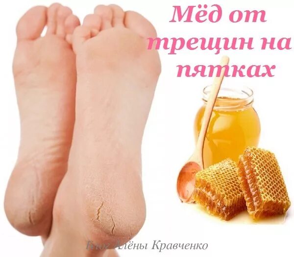 Как смягчить пятки. Народные средства от трещин на пятках. мед от трещин на пятках. обработка трещин на пятках. народное средство от пятки на трещине.