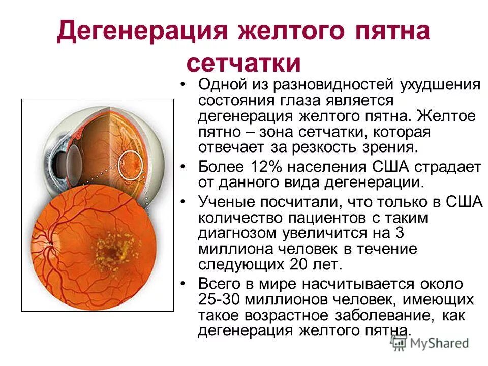 Слепое и желтое пятно сетчатки. Дегенерация желтого пятна. Желтое пятно сетчатки. Строение желтого пятна сетчатки.