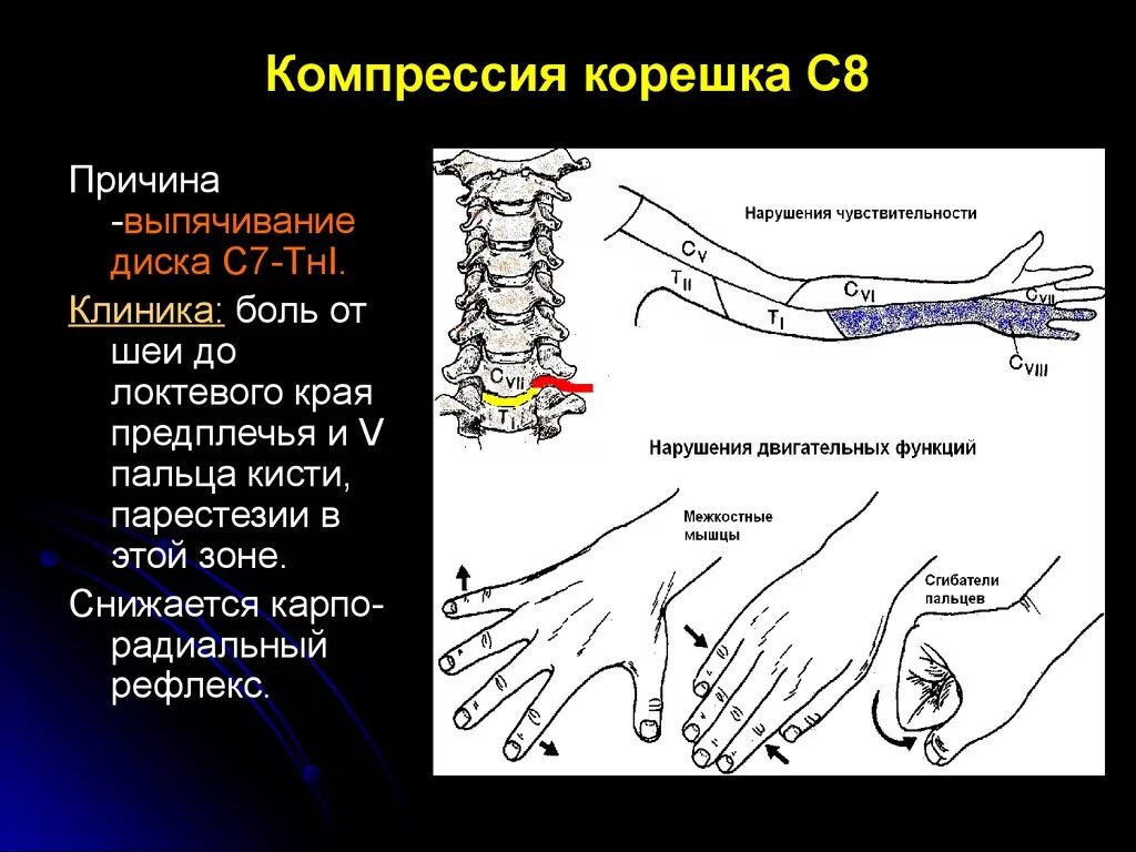 Радикулопатия с6. Компрессия s1 корешка позвоночника.. Синдром компрессии корешка s1. Корешок с5-с6 компрессия. Компрессия l5 корешка клиника.