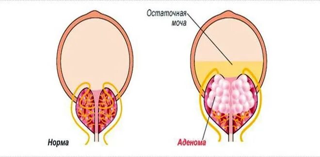 Остаток мочи у мужчин. Остаточная моча в мочевом пузыре. Норма остаточной мочи в мочевом пузыре. Остаточная моча в мочевом пузыре у мужчин при аденоме.
