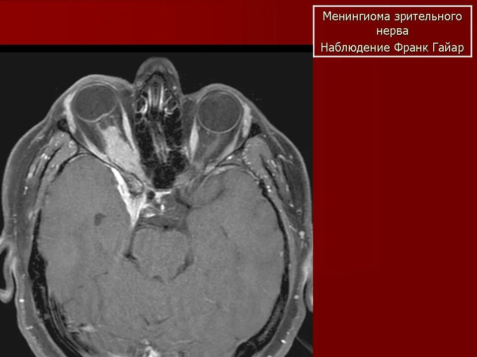 Мрт глазного нерва. Менингиома зрительного нерва мрт. Глиома зрительного нерва мрт. Невринома зрительного нерва мрт. Менингиома орбиты глаза.