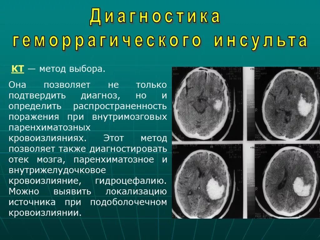 Был геморрагический инсульт. Геморрагический инсульт головного мозга кт. Геморрагический инсульт мозга на кт. Методы исследования при геморрагическом инсульте. Геморрагический инсульт диагноз.