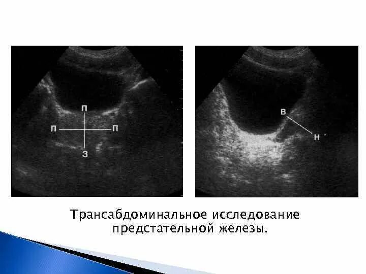 УЗИ предстательной железы трансабдоминально. УЗИ простаты и мочевого пузыря трансабдоминально. УЗИ предстательной железы норма трансабдоминально. УЗИ простаты Диагностер. Рецидив предстательной железы