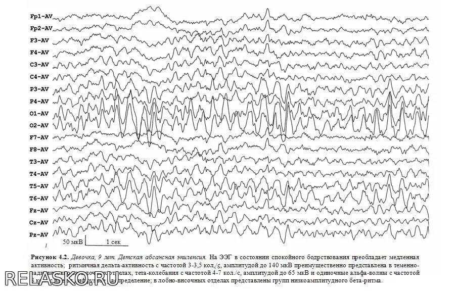 Нормы ээг у детей. Нормальная диаграмма ЭЭГ. Электроэнцефалография головного мозга (ЭЭГ). ЭЭГ головного мозга показатели. Энцефалограмма головы нормальные показатели.